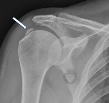 Calcific Tendinopathy Physio Treatment