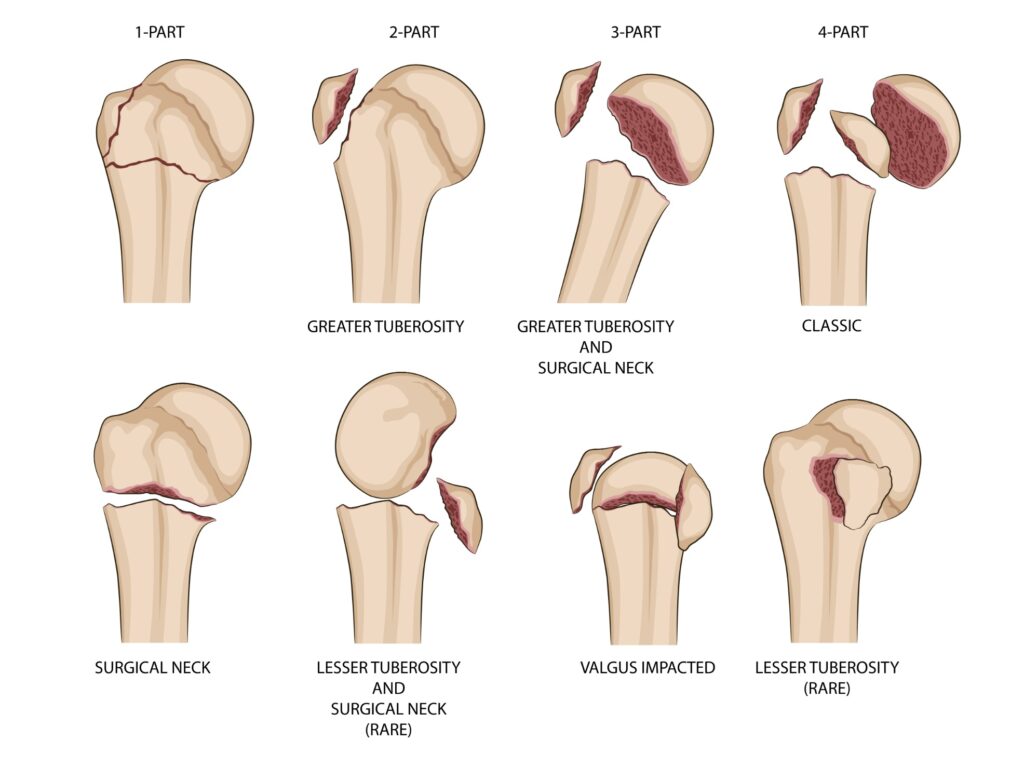 Shoulder Fracture Physiotherapy Melbourne - anatomy showing sites of shoulder fractures