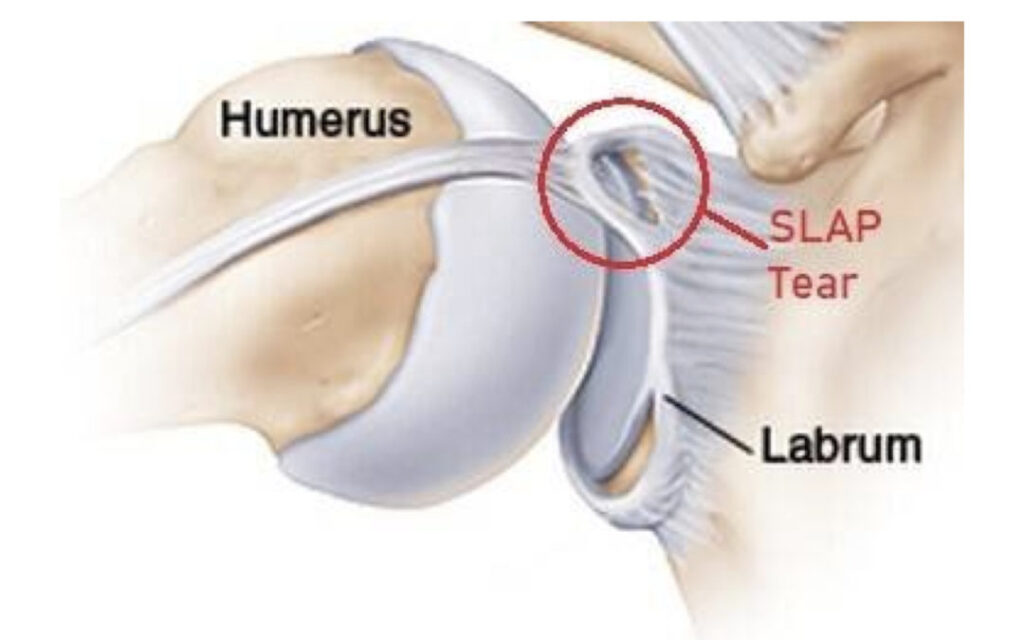 Anatomical illustration of the shoulder joint showing location of SLAP tear in the labrum