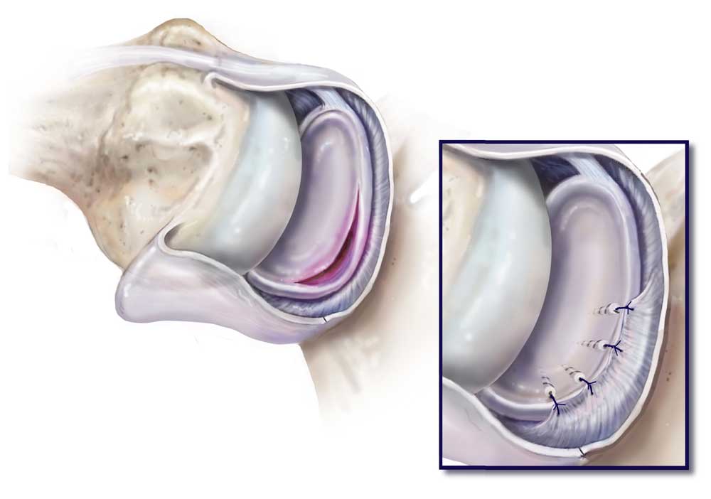 Diagram of a Bankart lesion showing the torn labrum at the lower front of the shoulder socket, with optional depiction of a bony fragment in a Bony Bankart lesion.